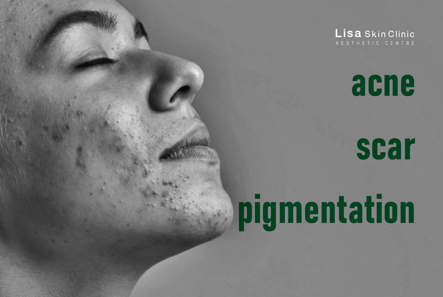 Signature laser treatment for Acne, Scar, Pigmentation with Exosome at Lisa Skin clinic - aesthetic centre using Deka Punto, Deka redtouch. Advanced Acne clinic at Lisa Skin Clinic by Dr Jenny Mathew in Kerala, India. Zimmer Cryo 7 for Painless Co2 Laser with no Downtime.